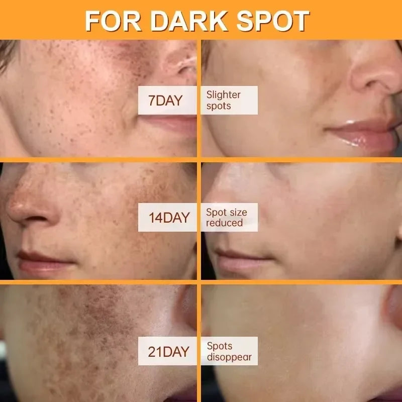 Whitening Freckles Face Cream Removal Melasma Dark Spots Corrector Lighten Melanin Pigmentation Brighten Anti-Aging Beauty Care